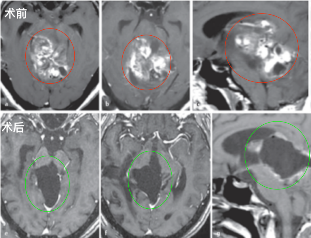 膠質瘤案例圖片
